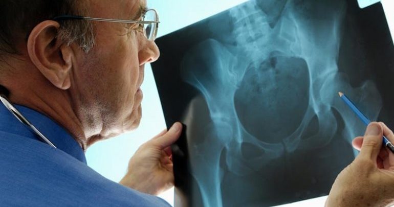Η θεραπεία με DHEA προλαμβάνει την οστική απώλεια στις γυναίκες Η θεραπεία με DHEA προλαμβάνει την οστική απώλεια στις γυναίκες