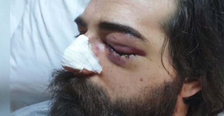 Σοκ: Φίλαθλος κινδυνεύει να χάσει το μάτι του από χτύπημα αστυνομικού στο ντέρμπι Παναθηναϊκός-Ολυμπιακός Σοκ: Φίλαθλος κινδυνεύει να χάσει το μάτι του από χτύπημα αστυνομικού στο ντέρμπι Παναθηναϊκός-Ολυμπιακός