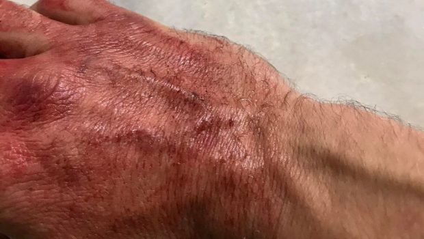 ΣΥΡΙΖΑ: Επίθεση από χρυσαυγίτες σε μέλος του κόμματος στο Ζεφύρι