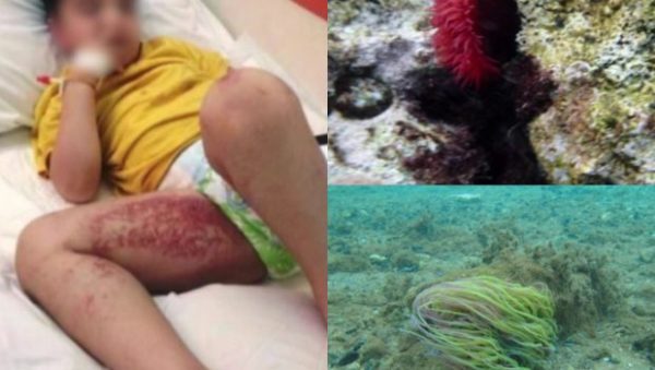 Θαλάσσιες ανεμώνες χτύπησαν κολυμβητές στο Ναύπλιο – Προκαλούν δερματικά εκζέματα