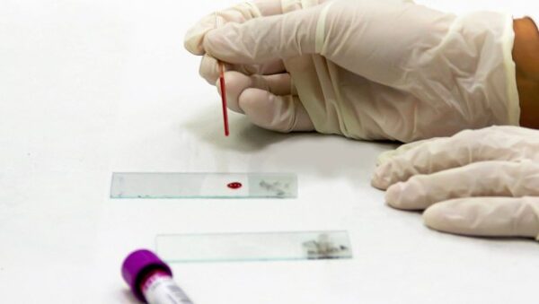 Τεστ αίματος ανιχνεύει τη νόσο του Crohn χρόνια πριν από την εμφάνιση συμπτωμάτων