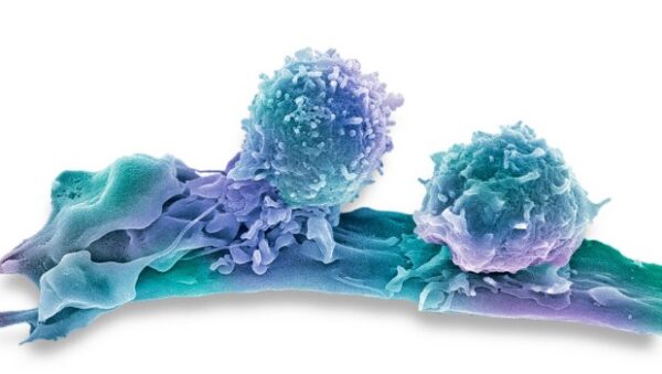 Καρκίνος: Σταθερά στο 7% των δαπανών υγείας – Βελτιώνεται η επιβίωση