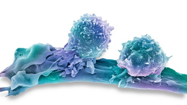 Καρκίνος: Σταθερά στο 7% των δαπανών υγείας – Βελτιώνεται η επιβίωση